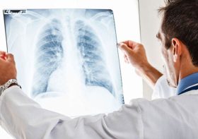 Lung Scarring: Is Scarred or Scared Lung Tissue Removal Necessary?